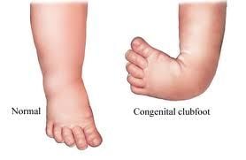 CLUBFOOT  NEDİR ?