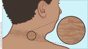 Acanthosis Nigricans Nedir?