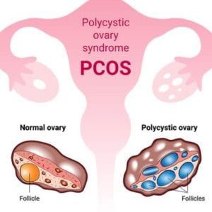 PCOS İÇİN DESTEKLER