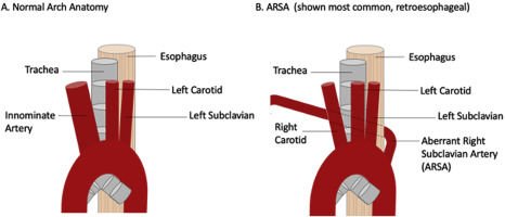 ARSA (Anormal sağ subklavyen arter) NEDİR ?